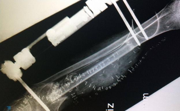 Radiografía de la pierna tras el trasplante.