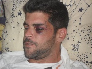 Rafael Jurado (29 años) ingresó en el hospital inconsciente y con un gran hematoma en el ojo izquierdo, entre otras lesiones.:: Juan Cano/